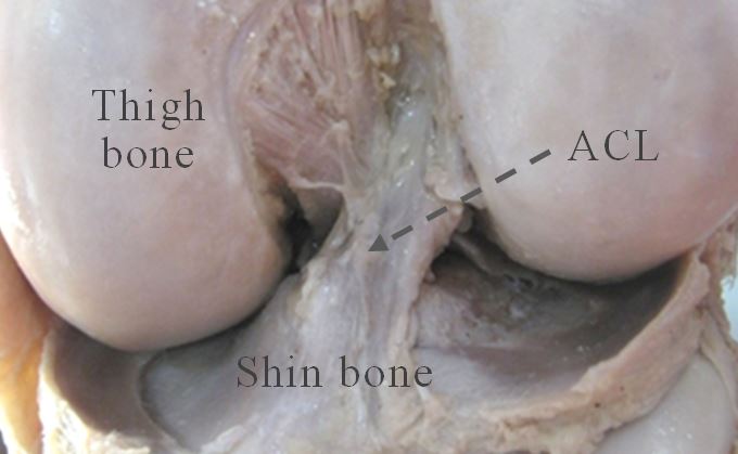 acl-reconstruction-surgery