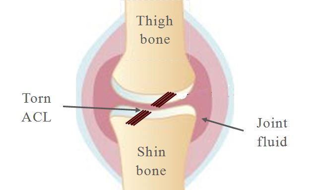 acl-reconstruction-surgery