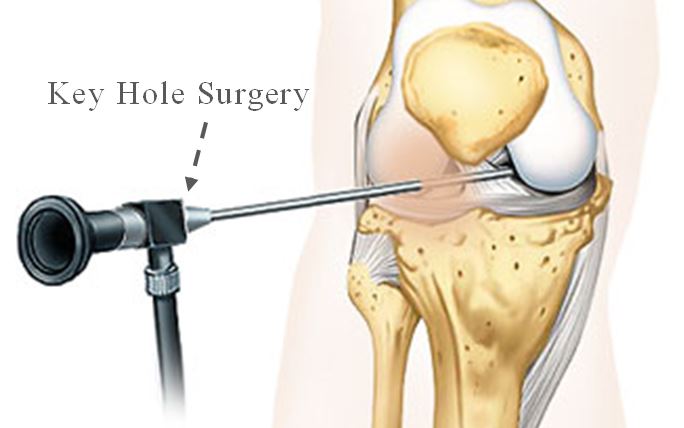 acl-reconstruction-surgery