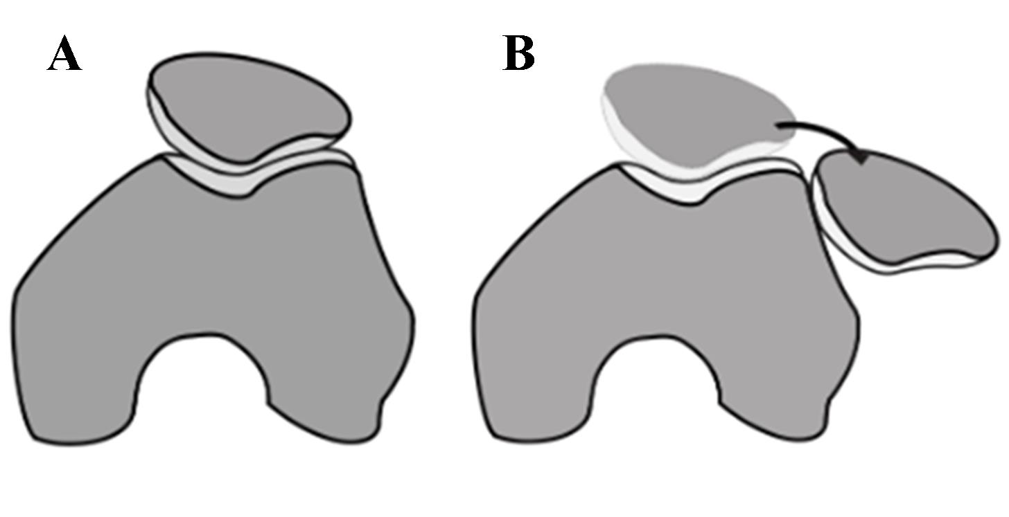 knee-cap-dislocation