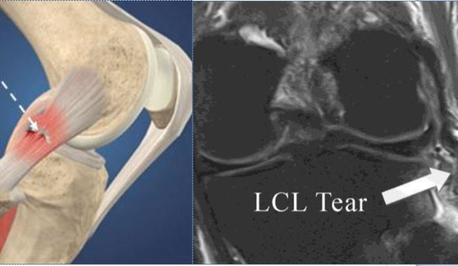 lcl-reconstruction-surgery