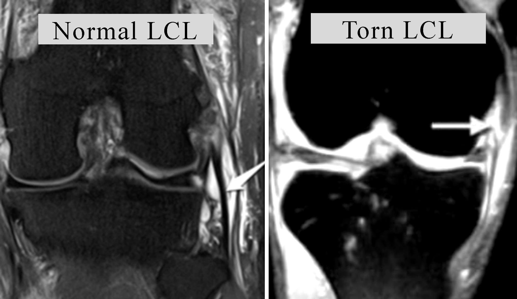 ligament-lcl-tear