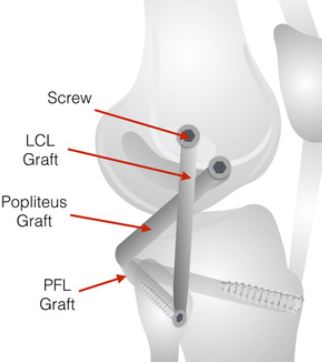 ligament-lcl-tear