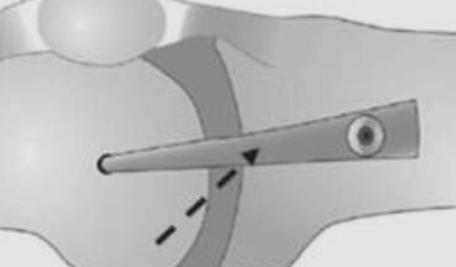 mcl-reconstruction-surgery