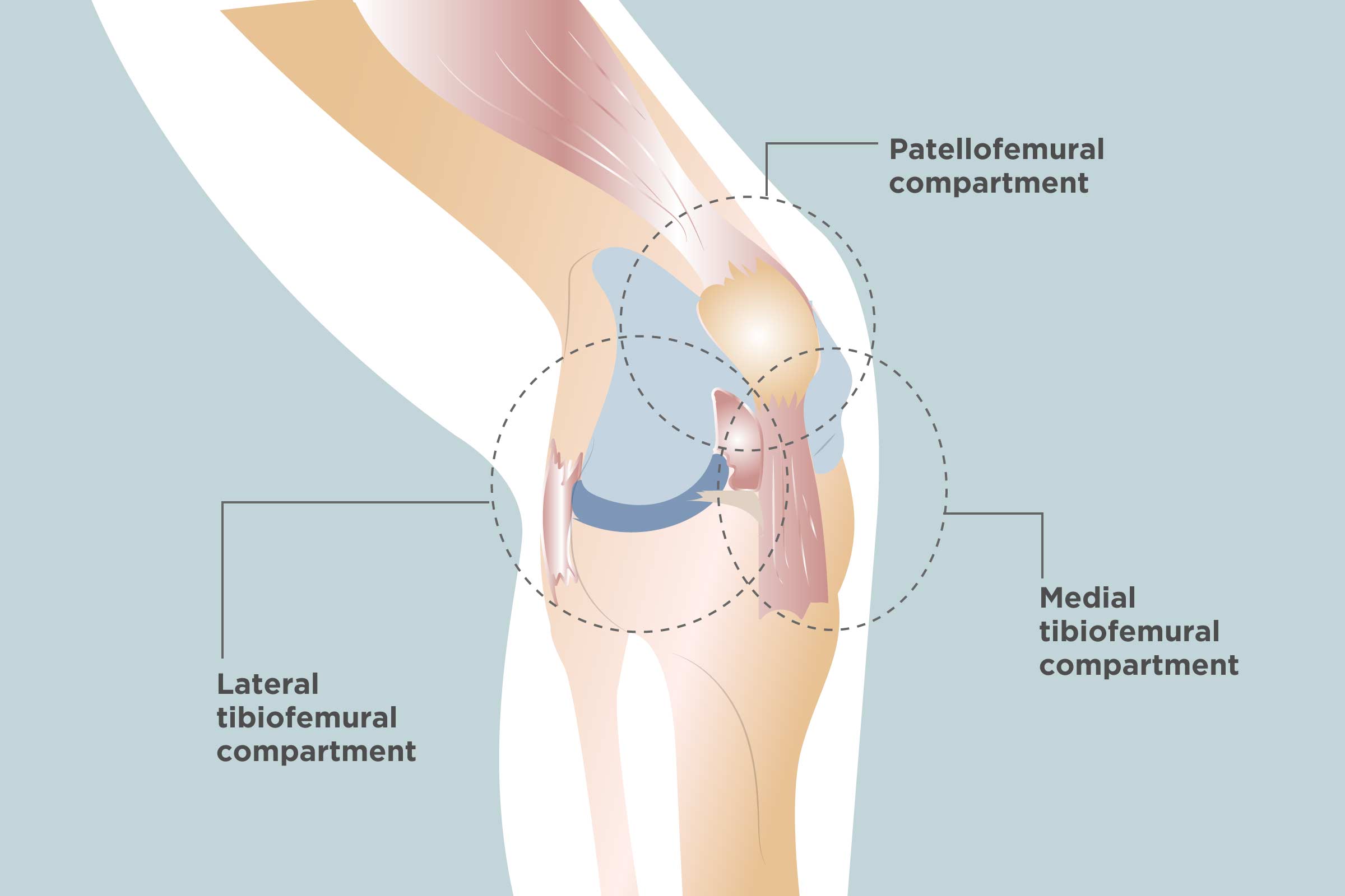 partial-knee-replacement