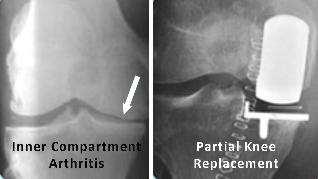 partial-knee-replacement
