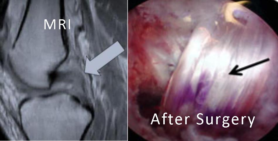 pcl-reconstruction-surgery