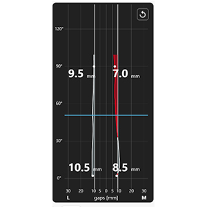robotic-knee-replacement