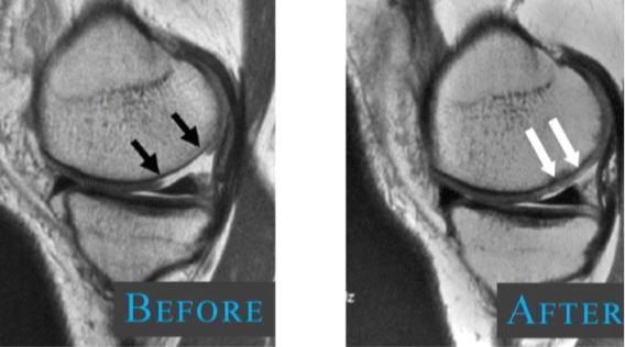 stem-cell-therapy-for-knee