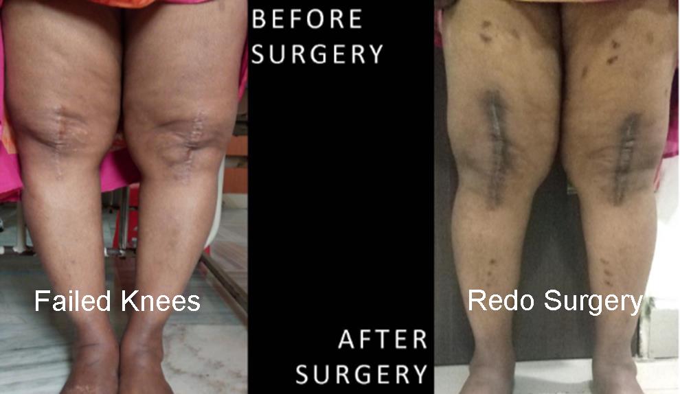 surgery-for-failed-knee-replacement