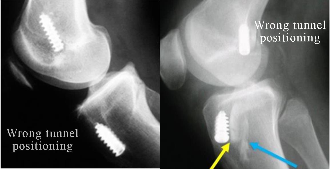 surgery-for-failed-ligament-reconstruction