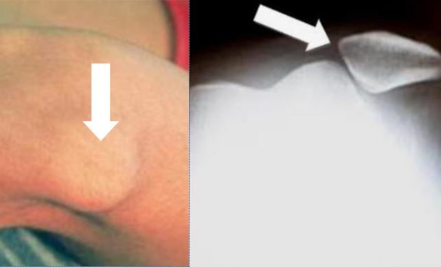 surgery-for-knee-cap-dislocation