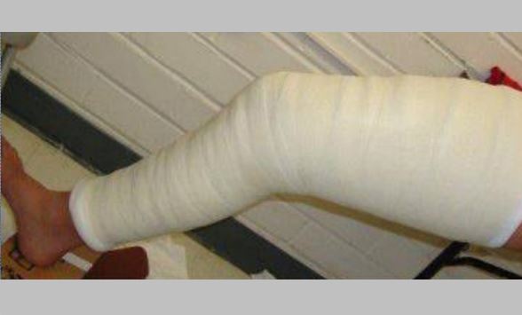 surgery-for-knee-cap-dislocation