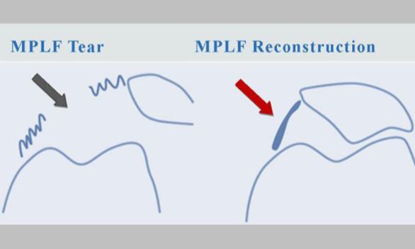surgery-for-knee-cap-dislocation